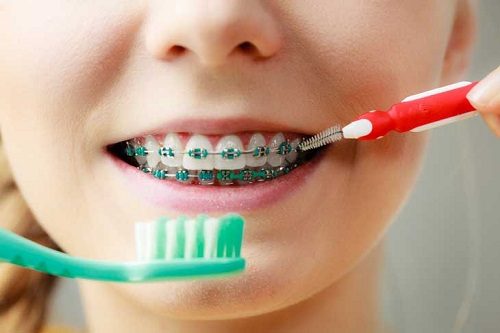Niềng răng có nên dùng bàn chải điện - Lợi ích từ bàn chải điện 2
