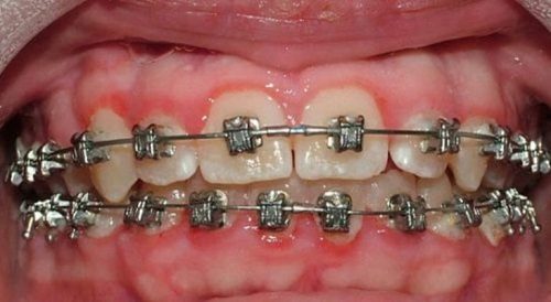 Niềng răng bị viêm lợi phải làm sao? 2