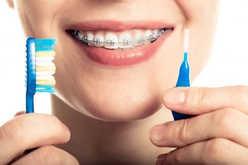 Niềng răng xong có nên tẩy trắng răng không? 3