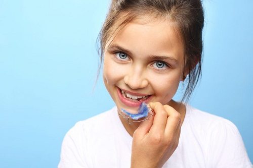 Dụng cụ niềng răng tại nhà 3 giai đoạn có gì đặc biệt? 3
