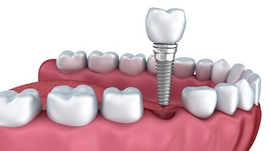 Trồng răng sứ bao nhiêu một cái - Bảng giá mới nhất 2